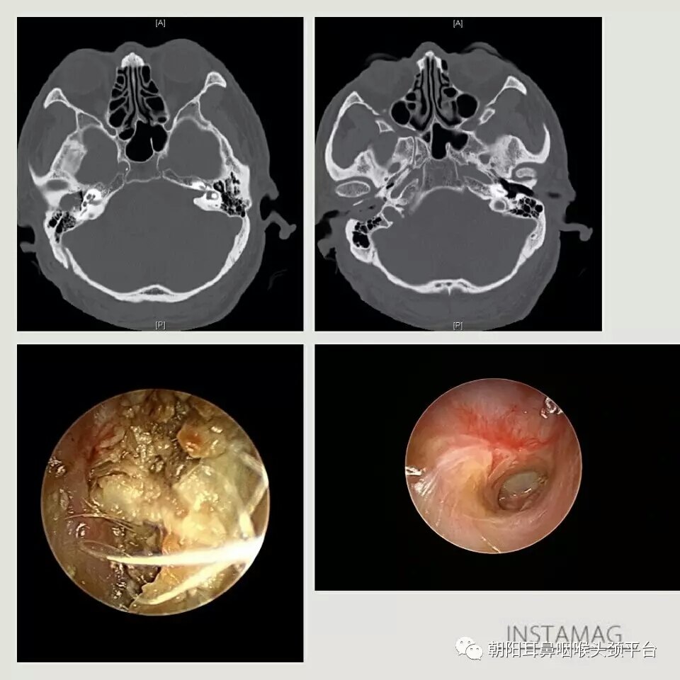 胆脂瘤是肿瘤吗