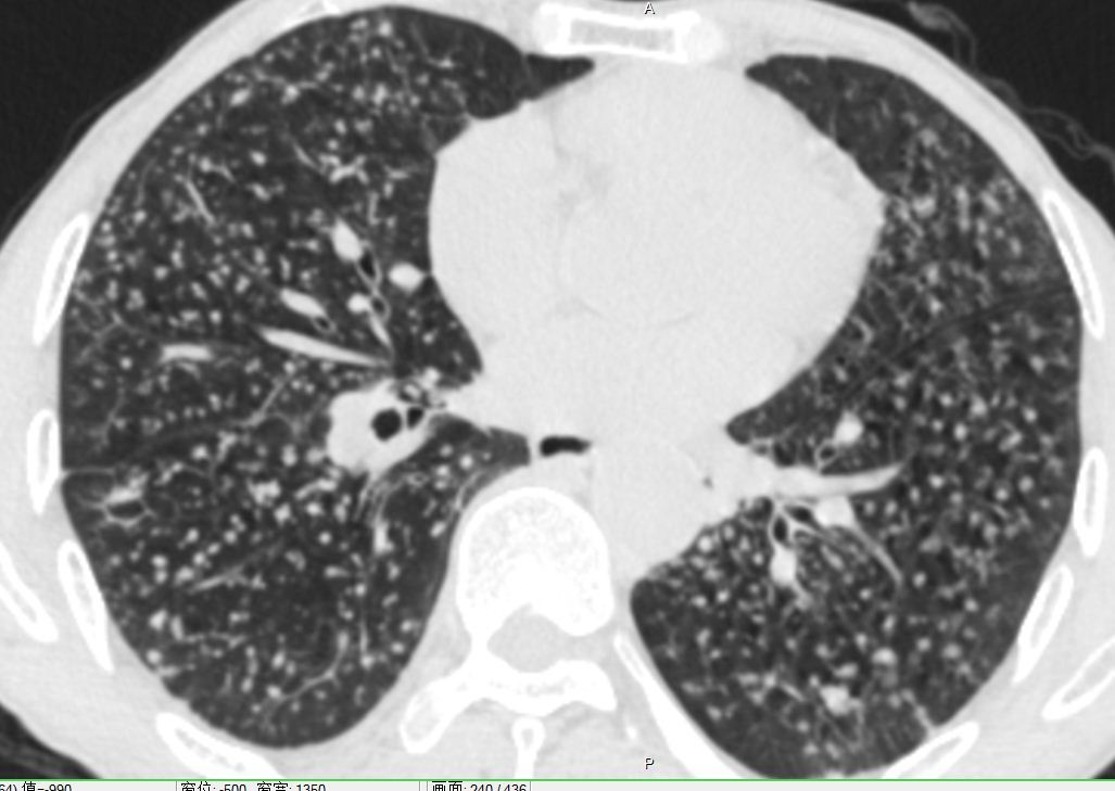 遇到尘肺莫慌张 (原创)_谢冬医生文章_上海市肺科医院-微医