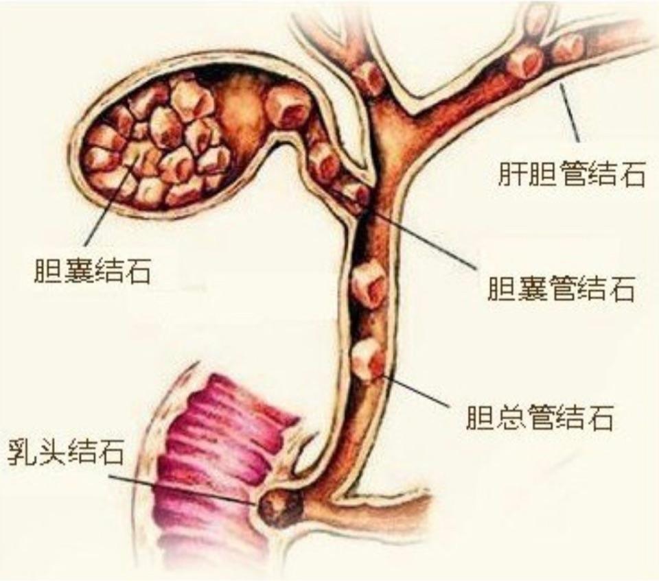 胆管支架手术费用 搜狗图片搜索