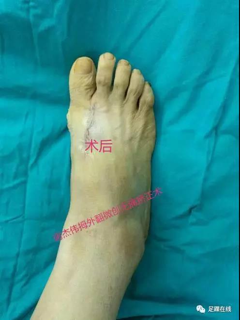 拇外翻俗称大脚骨的微创无痛美容矫正术