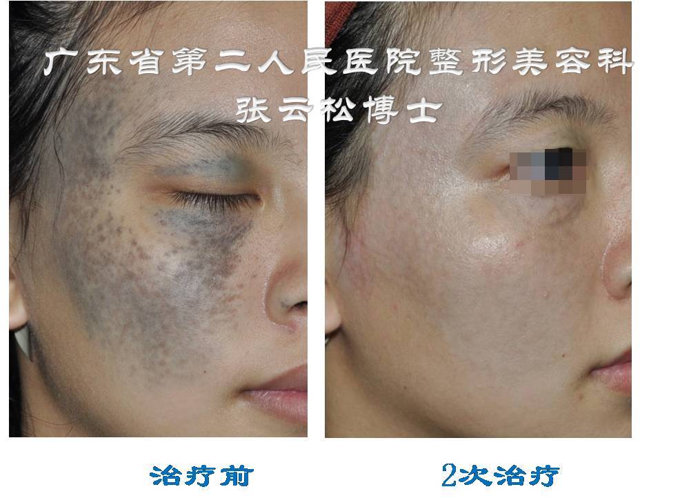 太田痣系列科普一患了太田痣我要恭喜您附对比图片
