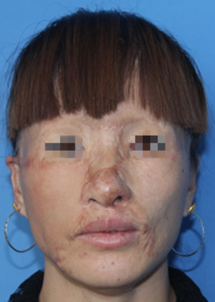 扩张器治疗面颈部大面积瘢痕常见问题