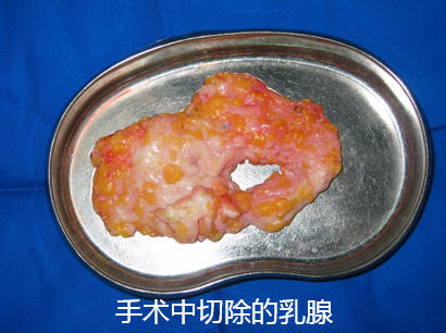 只能通过手术的方法切除,现在应用最多的小切口的男性乳房切除手术是