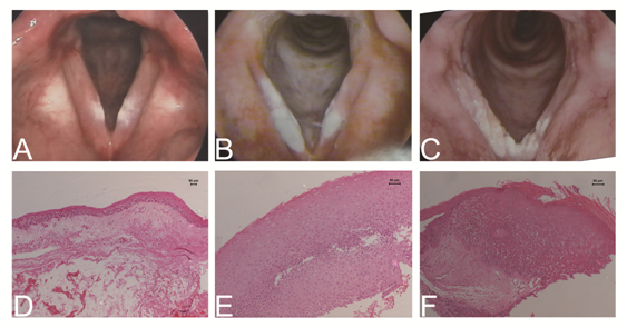 长什么样的声带白斑需要手术声带白斑系列研究之一