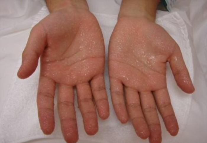 手出汗多是什么原因