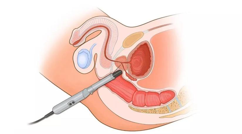 前列无忧 前列腺 尿道球腺 深度 按摩治疗 健康号 微医