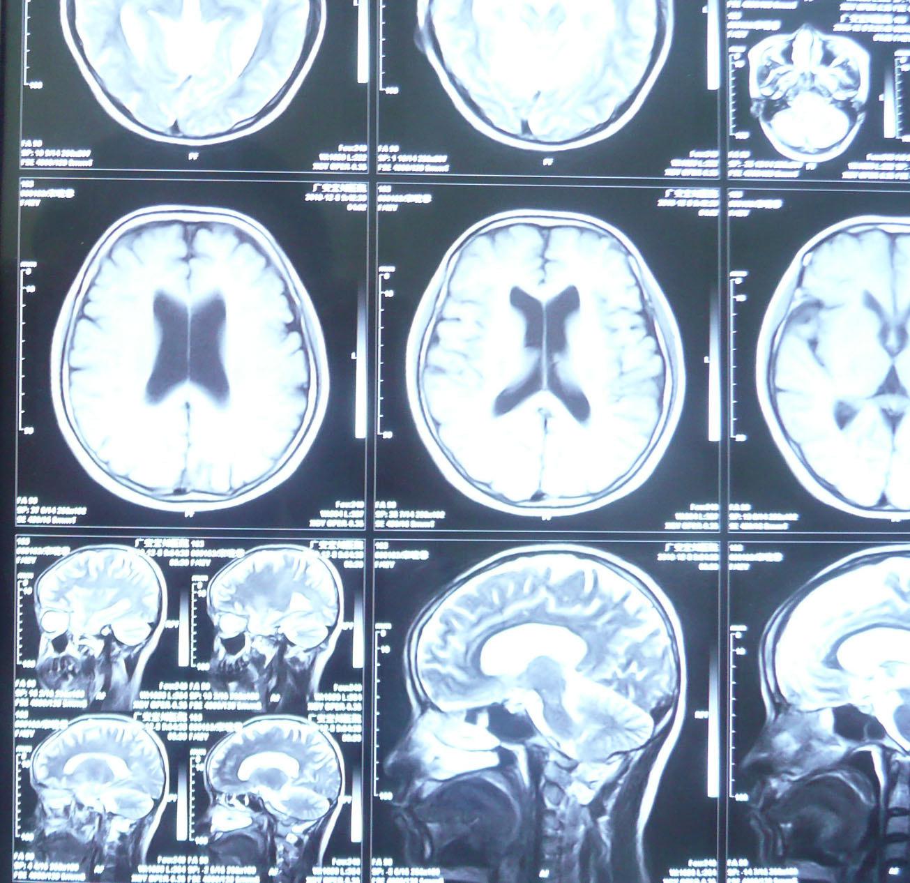 外伤性脑疝应用3D技术个体化治疗一例 - 脑医汇 - 神外资讯 - 神介资讯