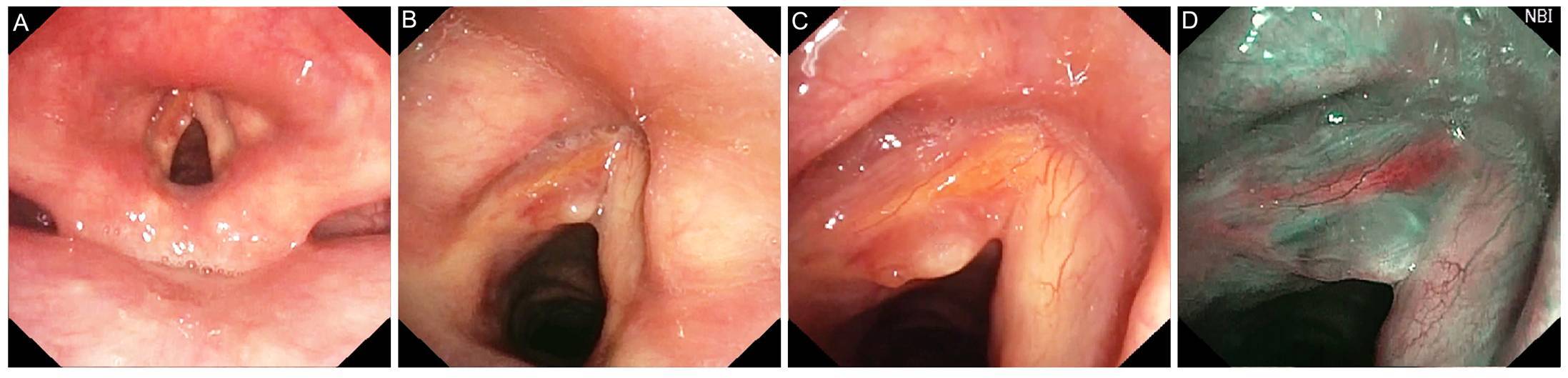 窄带成像内镜在声带息肉样病变中的鉴别诊断作用