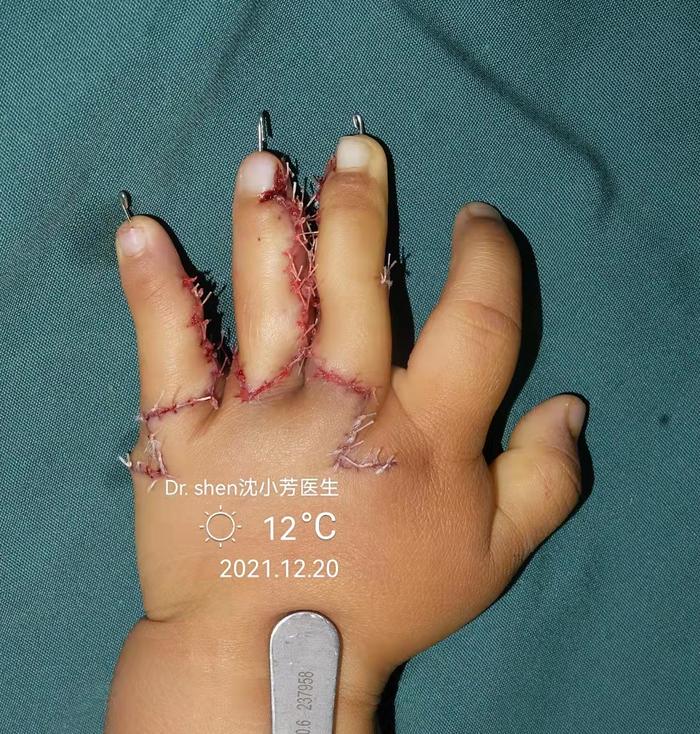 还是家族遗传的并指伴多指,还有双脚多趾,这次手术把左手三个手指一次