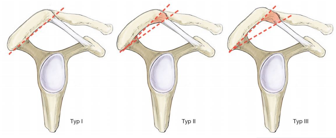 上图:肩峰下骨赘明显.上图:肩关节镜微创手术打磨掉肩峰下增生的骨赘.