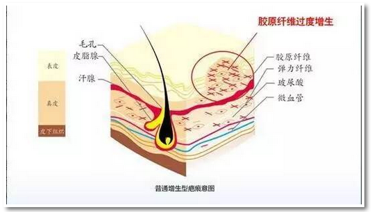 怀孕不想成为花肚皮怎么办孕前篇
