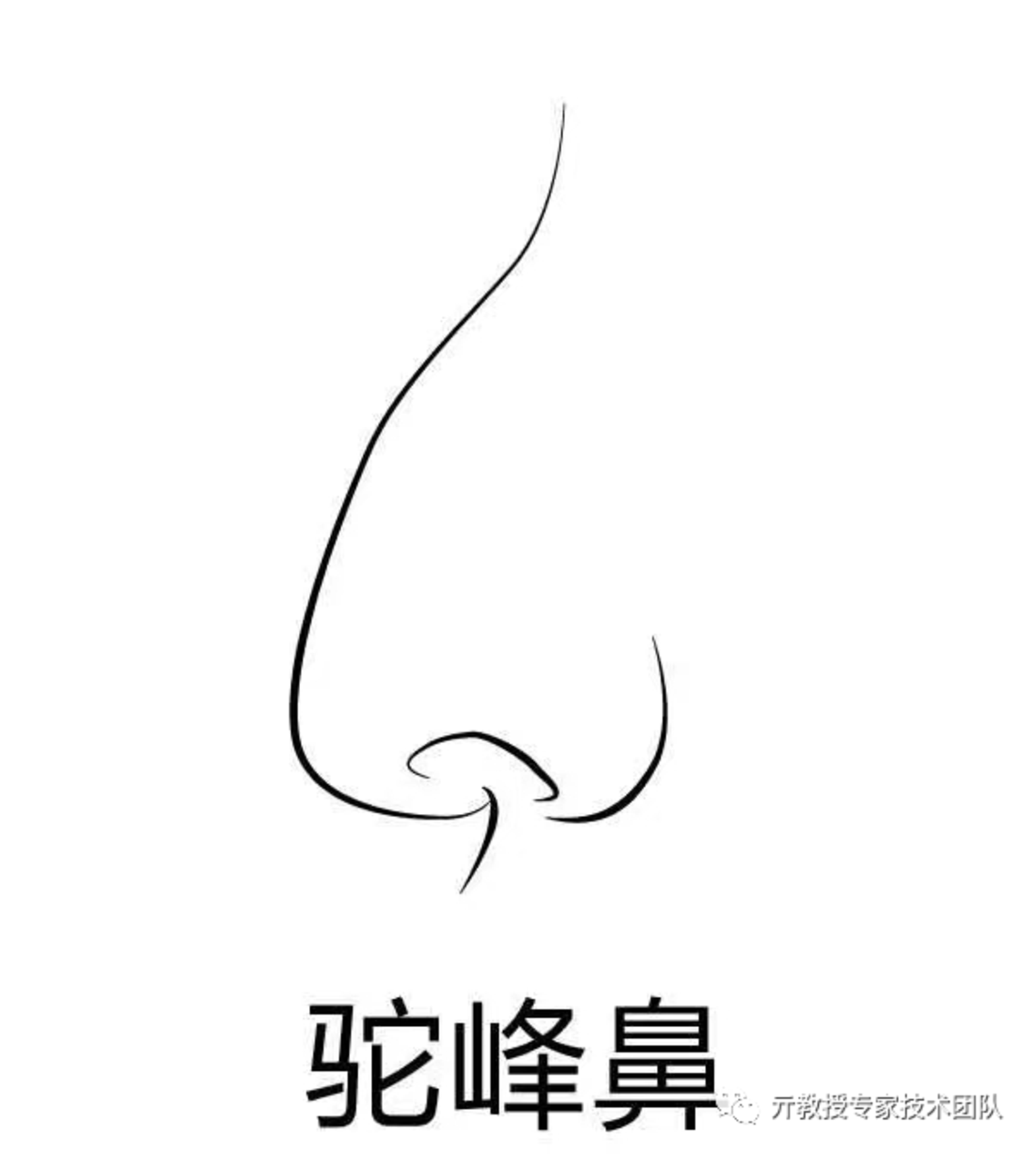 不完美鼻型之驼峰鼻