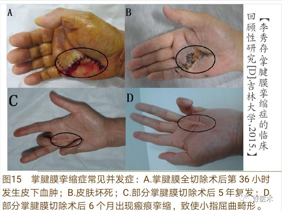 掌腱膜挛缩症的诊治技巧系统详解