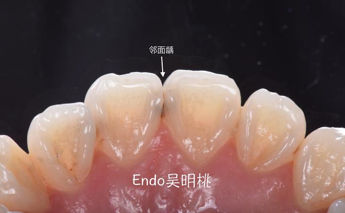 雾里看花的邻面龋