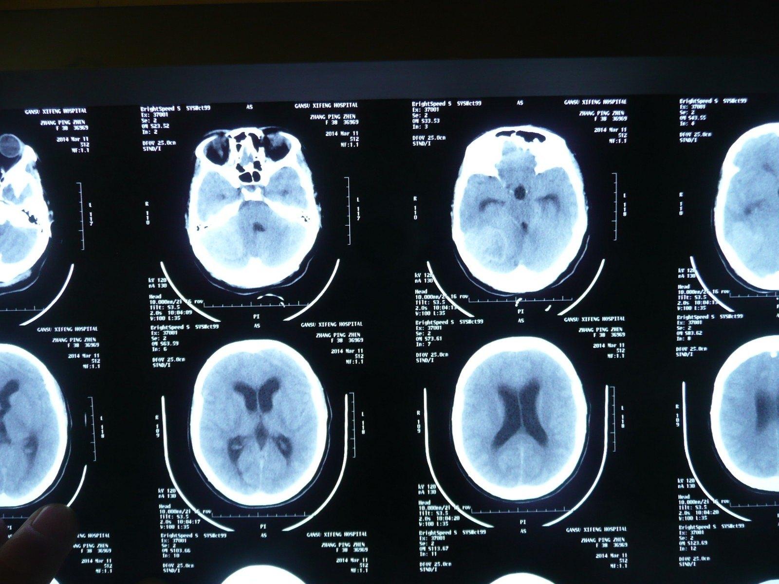 颅脑先天性疾病影像诊断_畸形