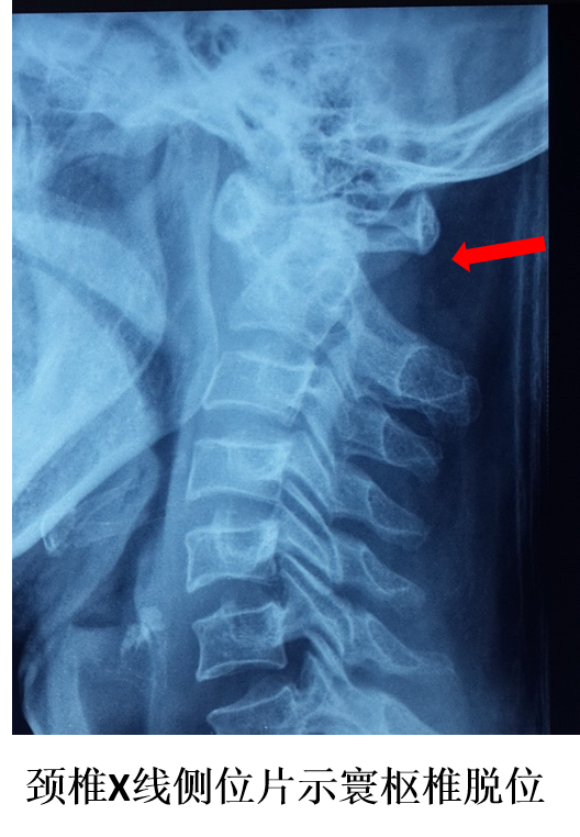 难复性寰枢椎脱位