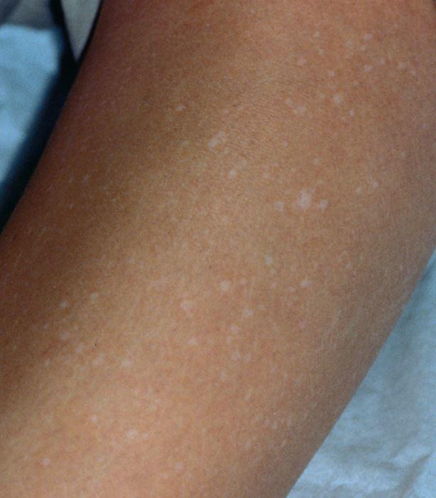 之后头皮某处出现簇状灰白色头发,需要关注,这可能是最早出现的症状