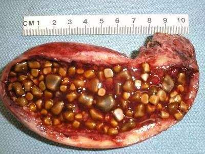 有人说胆囊切除后会增加大肠癌的发病风险,但这点还没有得到有力的