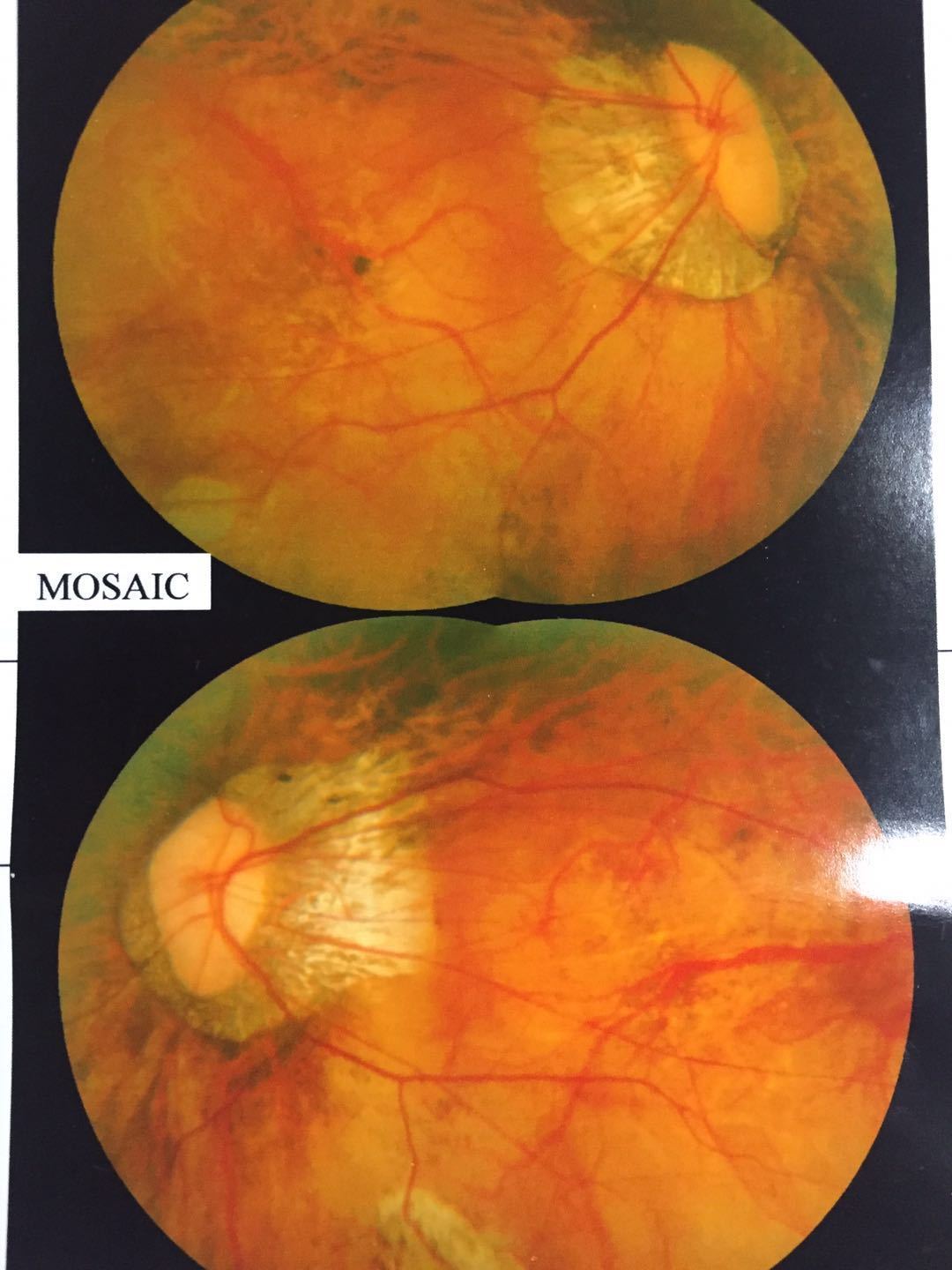 22mm,眼底形成所谓的后巩膜突,会导致眼底裂孔,出血,脱离等并发症
