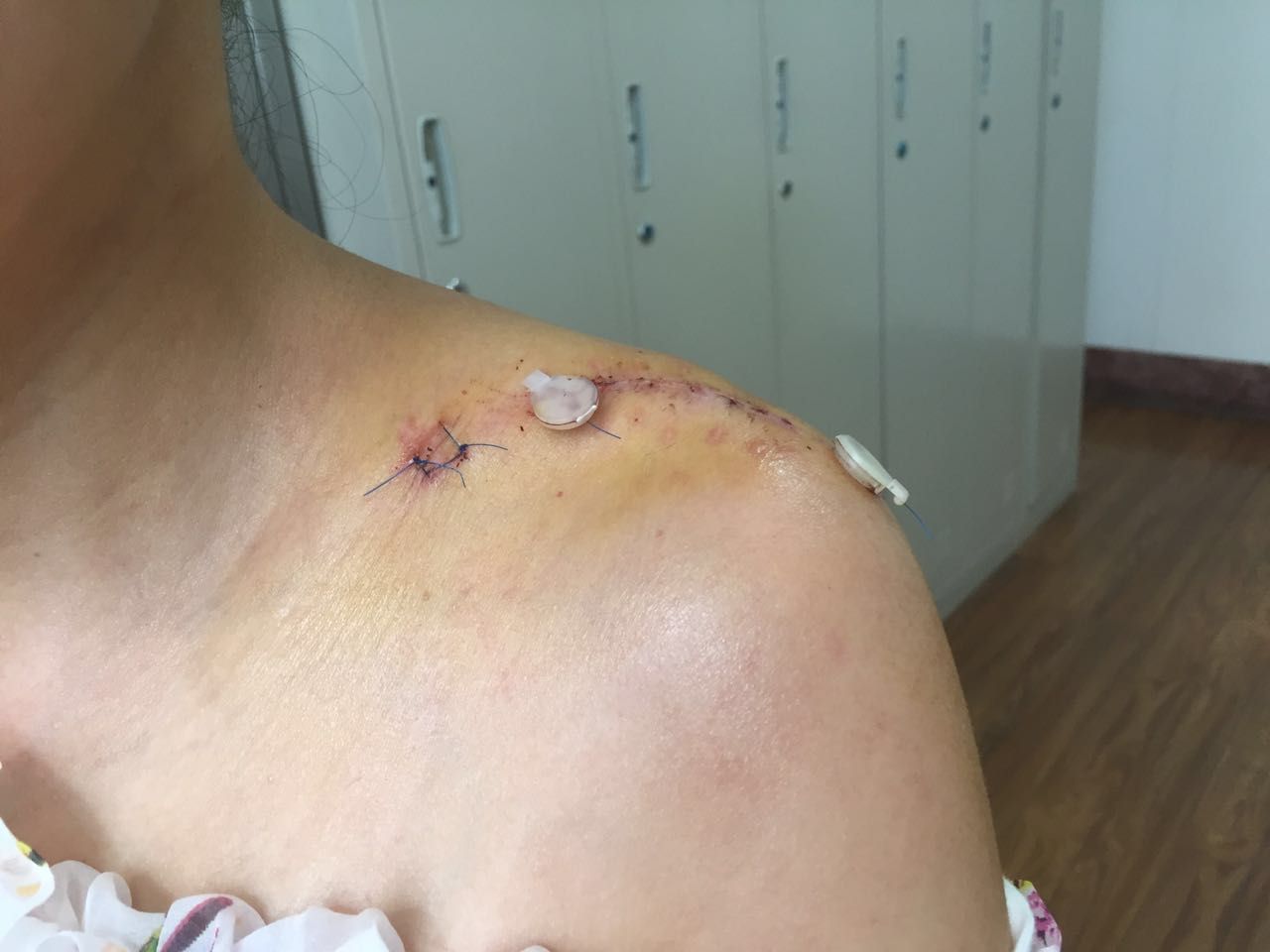 骨折内固定术,切口美容缝合术后美容缝合伤口愈合后效果取内固定的