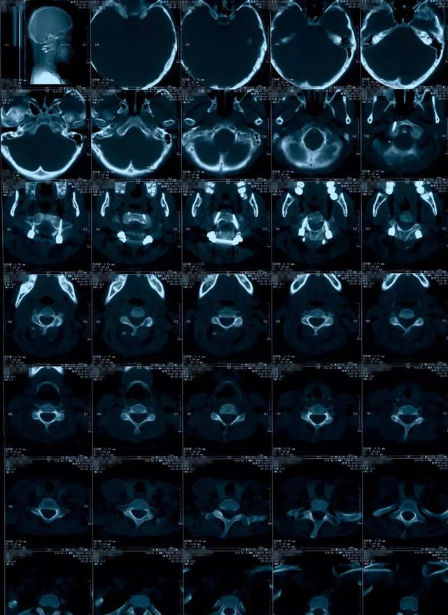 病例点评寰枢椎脱位1例