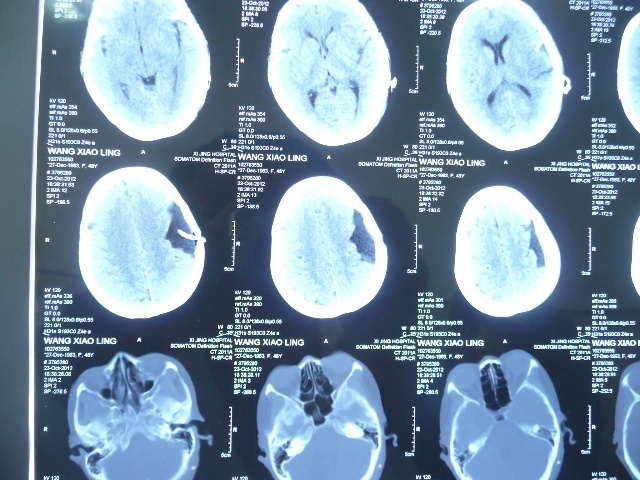 贺晓生教授囊肿不是肿瘤头痛也会扰人