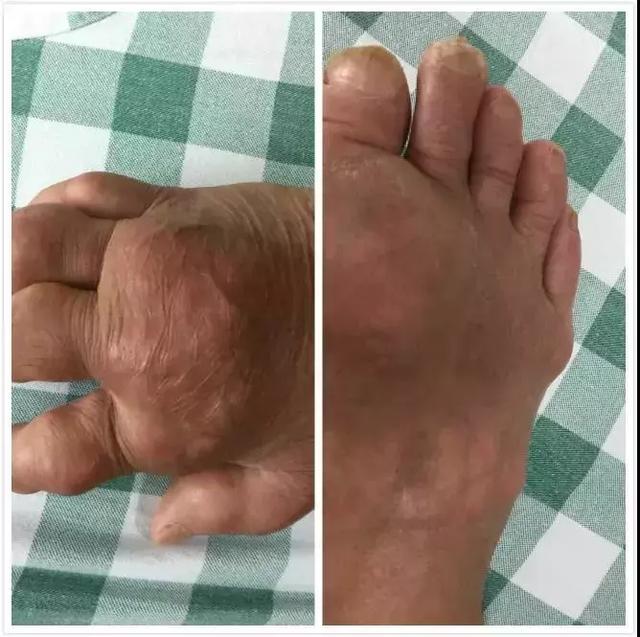 但较大的,长期存在的痛风石内部发生了纤维化和钙化,溶解需要的时间