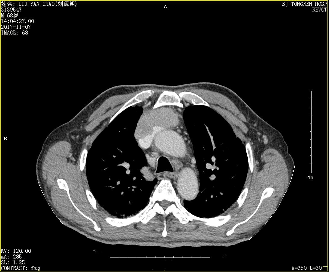 一例伴有重度皮肌炎的巨大胸腺癌在北京同仁医院得到成功救