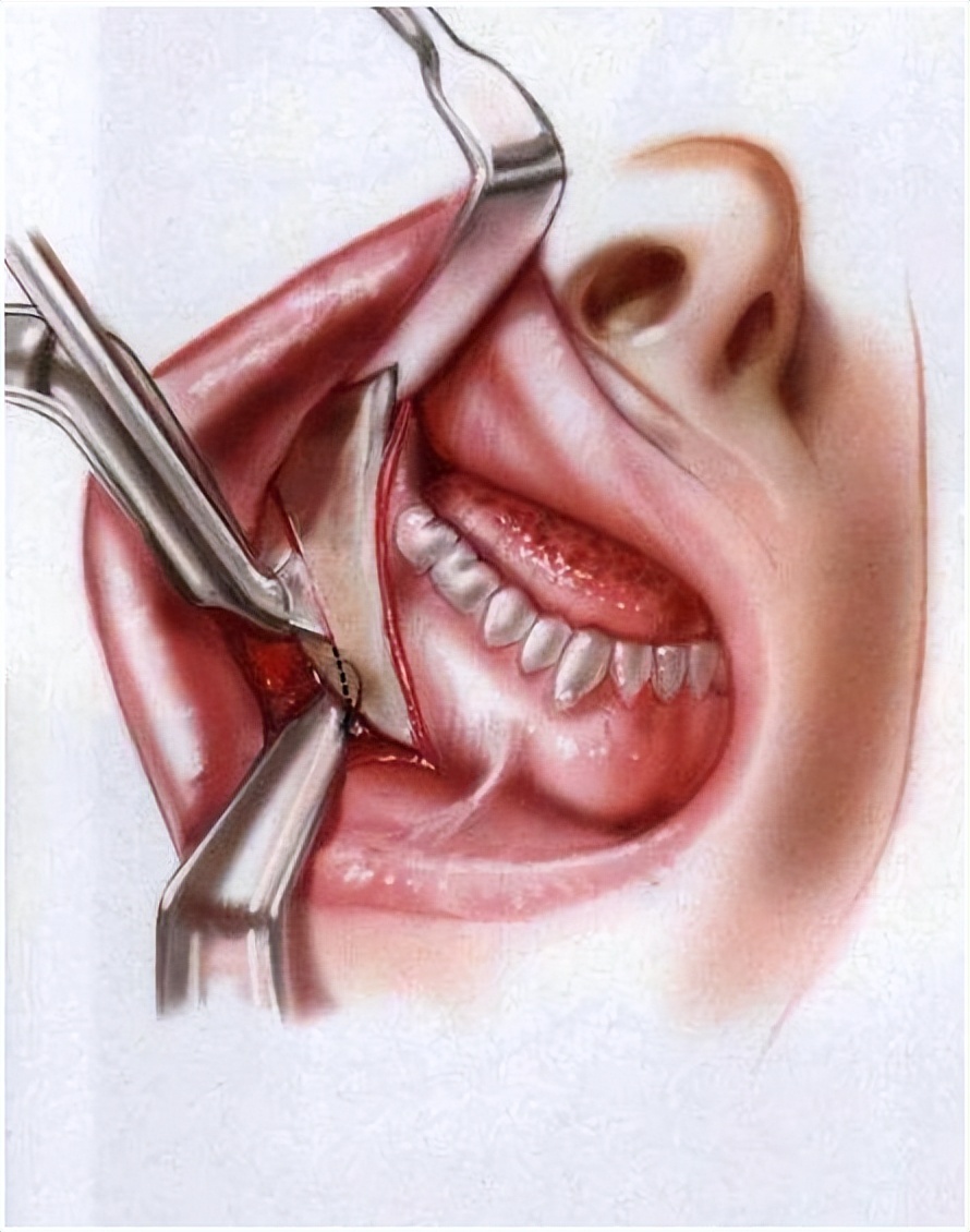 同时可以切除或磨削下颌骨外板和下颌缘,还可以同时切除部分咬肌