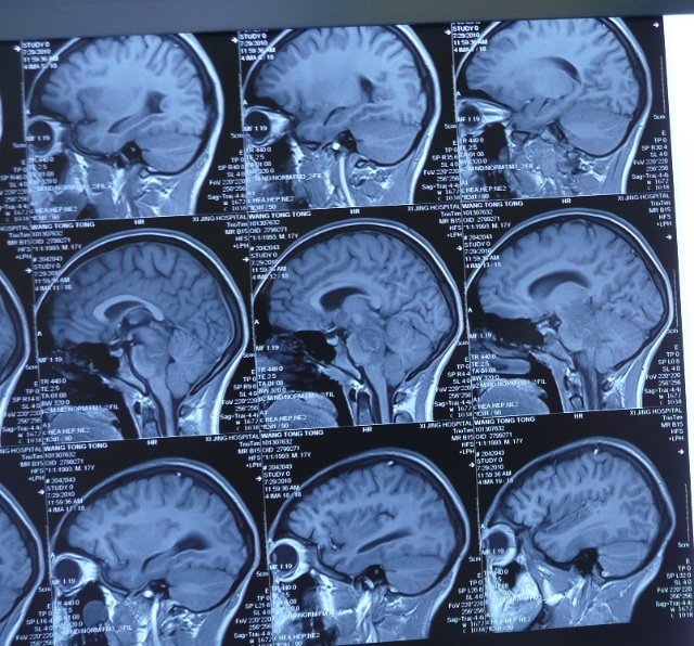 贺晓生教授脑干肿瘤少年术后2年回访