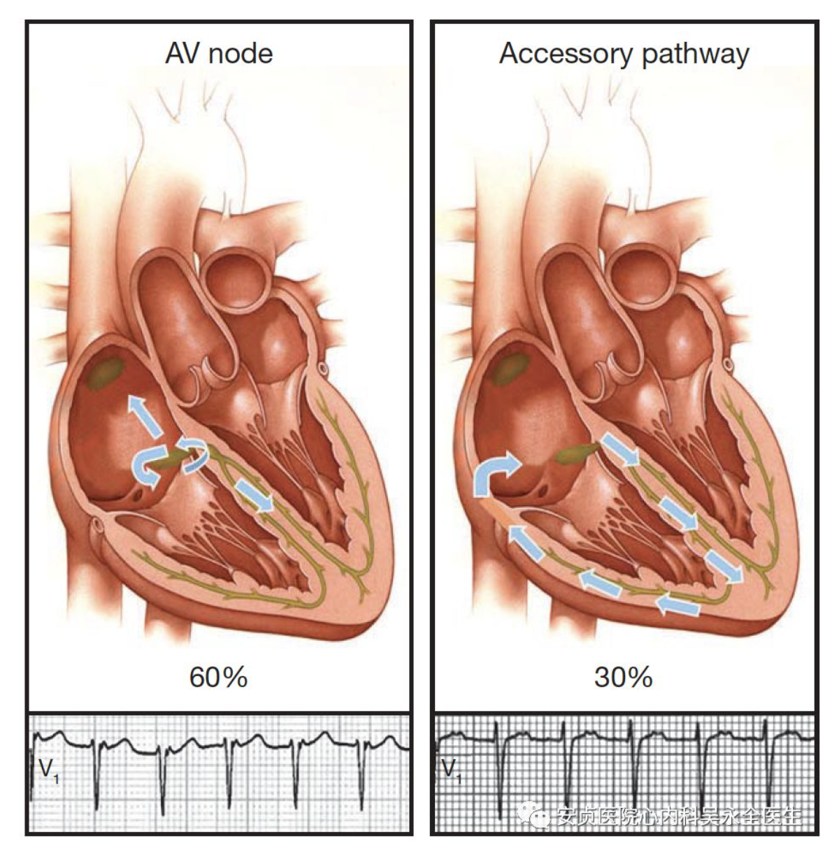 房室结主要起延迟传导的作用,若该功能异常(短pr综合征)便会影响心室