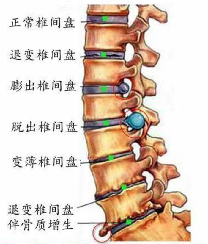 脊柱退变系列之腰椎退行性变是什么鬼是骨关节炎吗