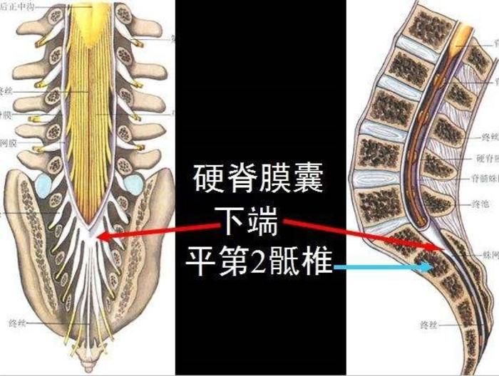 骶管囊肿是一种什么病怎么会得这种病的