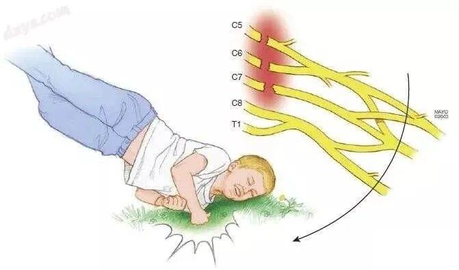 臂丛神经损伤疼痛怎么办