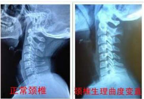 颈椎曲度变直我来教大家几招恢复曲度