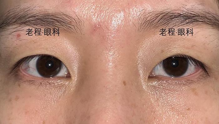 骨壁减压和脂肪减压,何种眼眶减压手术更佳?