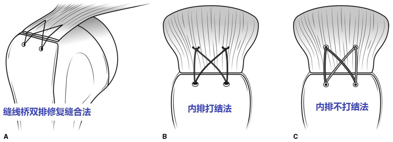 上图:缝线桥双排修复肩袖缝合法.小贴士:肩膀疼痛不等于肩周炎.