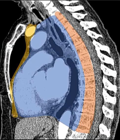 纵隔肿瘤是什么病?严重吗?