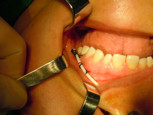 病人第二天腮腺区消肿再看一眼涎腺镜这是健侧正常的腮腺导管口在右侧