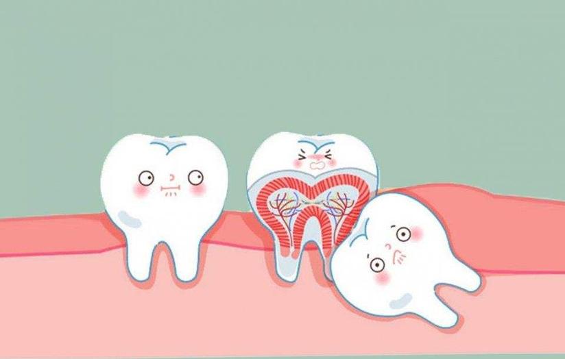 智齿不疼也不发炎 该不该拔 健康号 微医