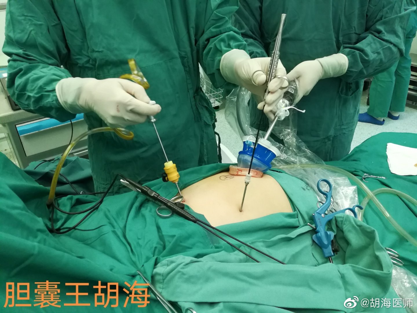 保胆取石到底是怎么回事