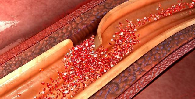 体内最大血管撕裂一旦破裂立即死亡主动脉夹层人体定时炸弹