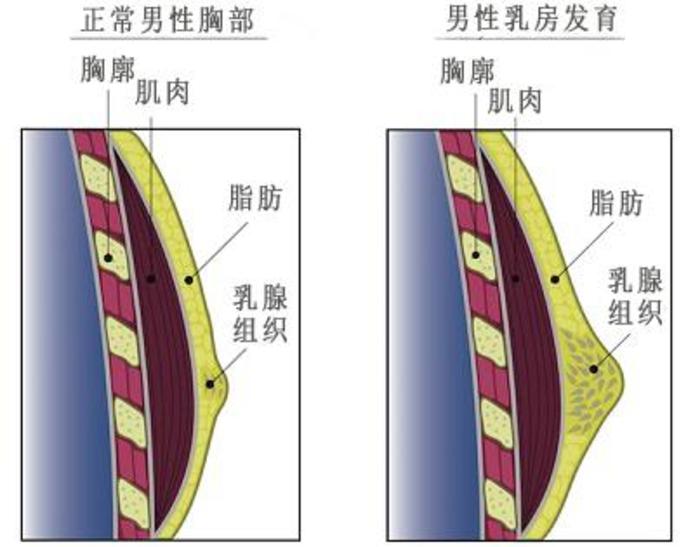 王永春医生访谈男乳矫形手术时吸脂的切口选在哪里好