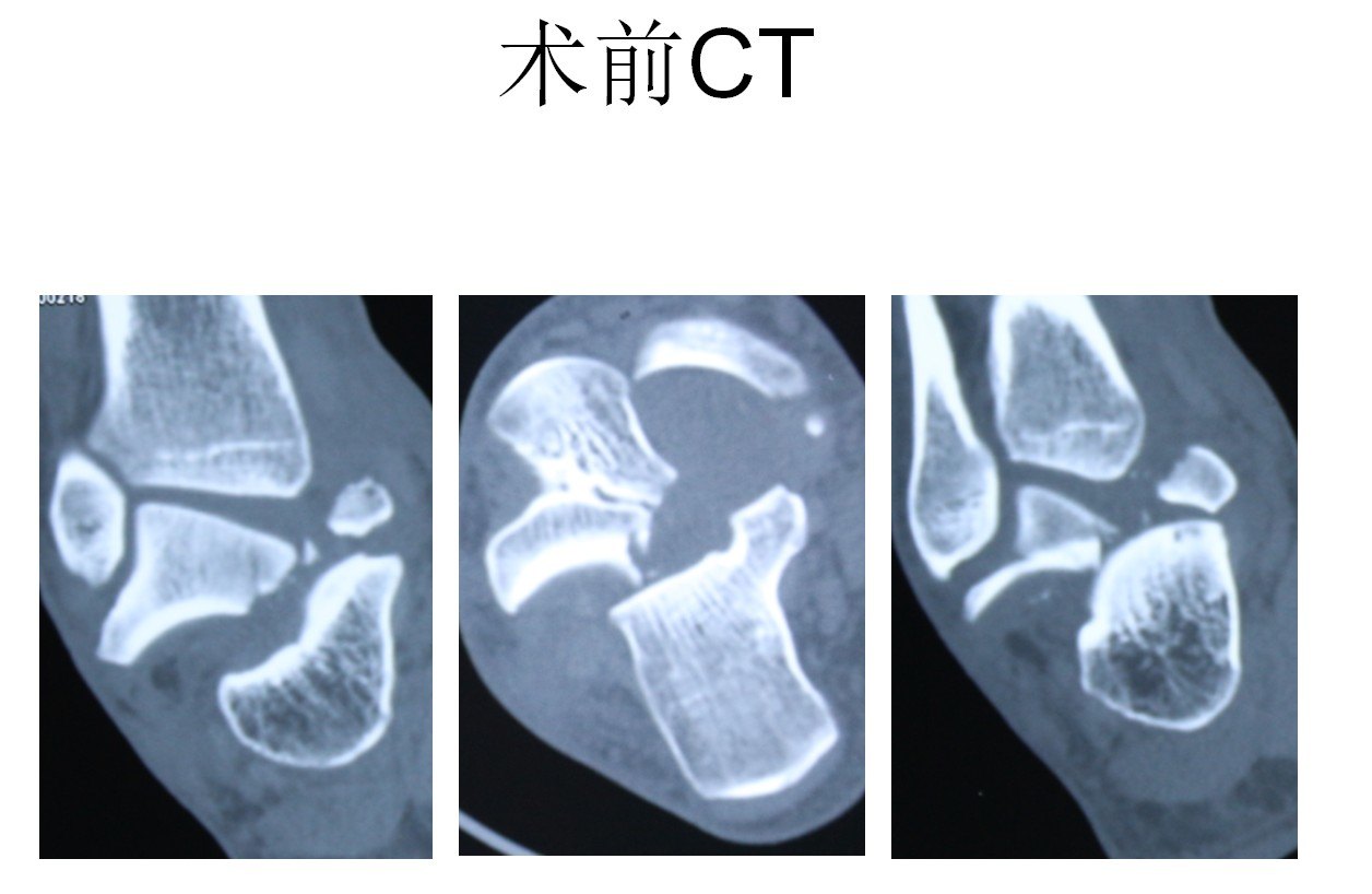 距骨根刺图片