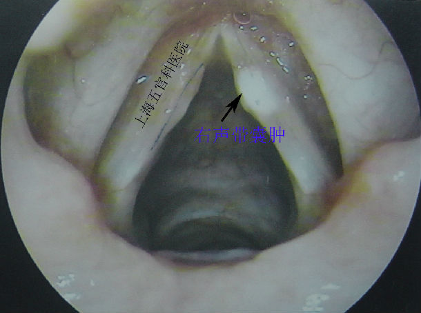 声带囊肿_吴海涛医生文章_复旦大学附属眼耳鼻喉科医院-微医(挂号网)