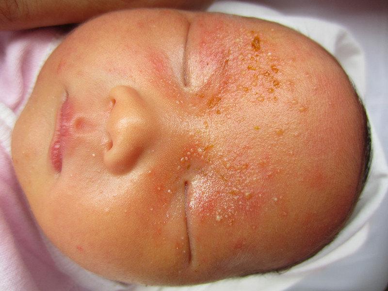 炎炎烈日五类夏季皮肤病爱找小宝宝