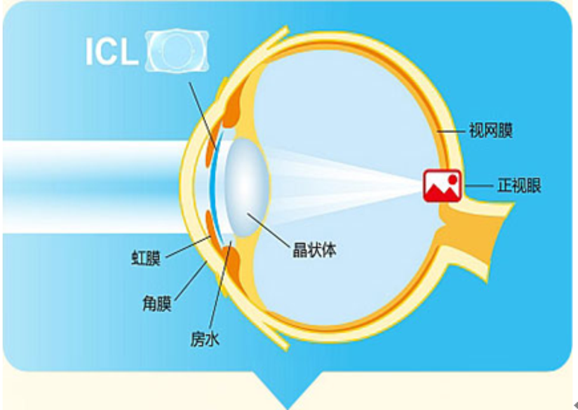 Icl 可植入式隐形眼镜 健康号 微医