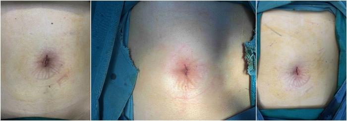 胆囊结石超微创手术单孔