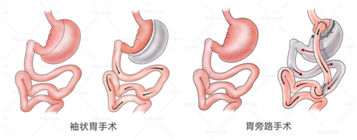 減肥手術多少錢_減肥手術切胃_手術減肥