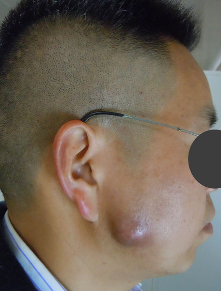 慢性腮腺炎转化为腮腺脓肿有图片